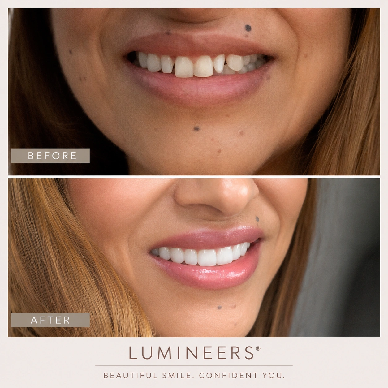 Before and after Lumineers cosmetic dental treatment