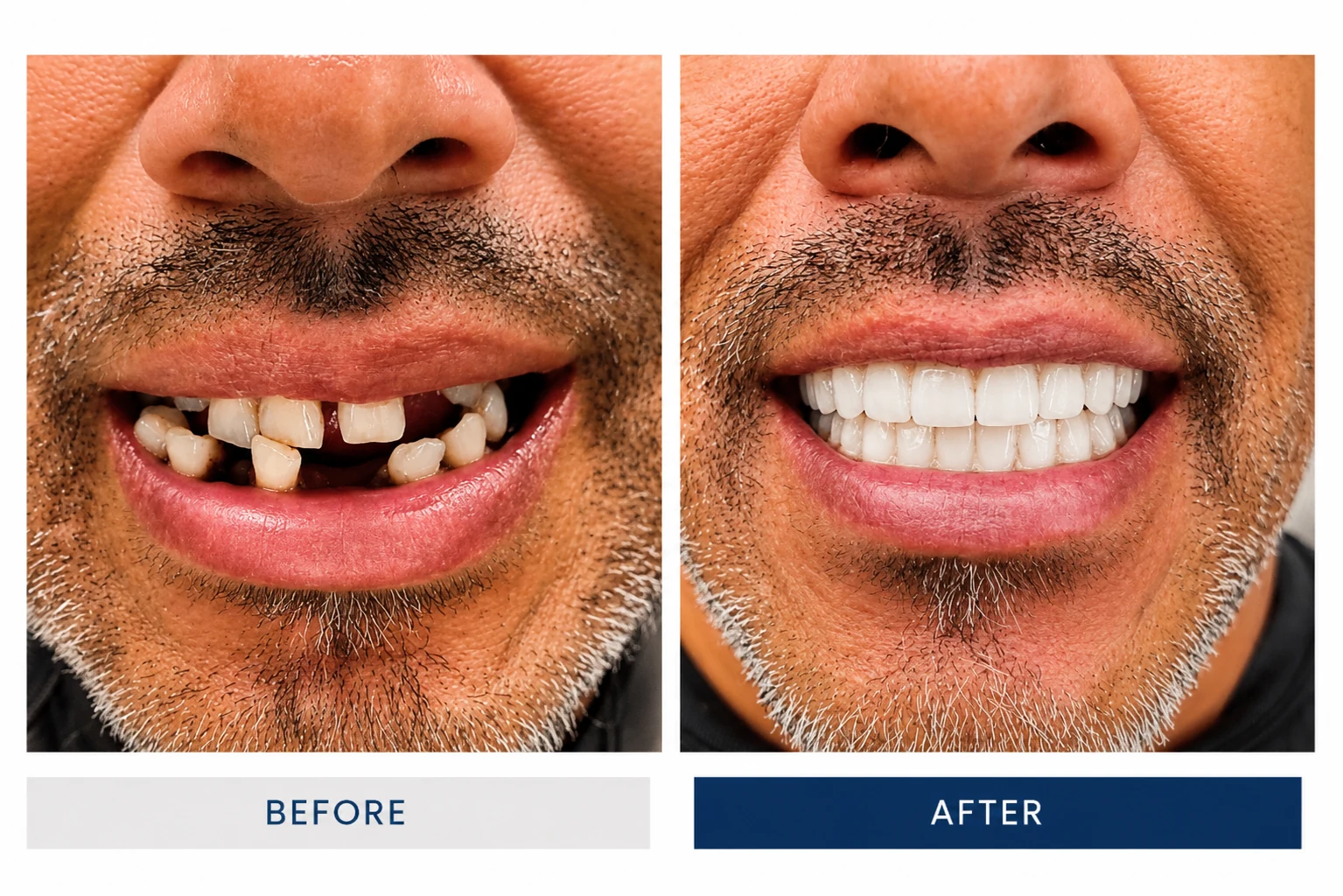 Before and after All-on-6 dental implants full smile restoration