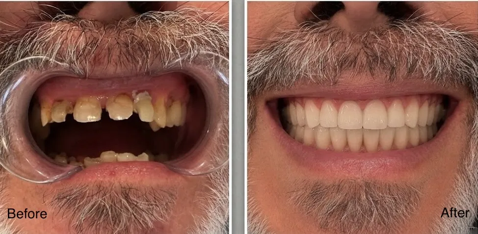 Real patient before and after dentures showing missing teeth replaced and improved facial support