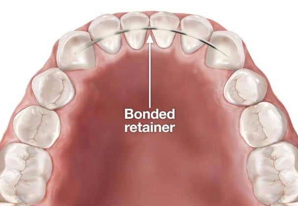 Bonded fixed retainer example showing a wire placed behind the front teeth