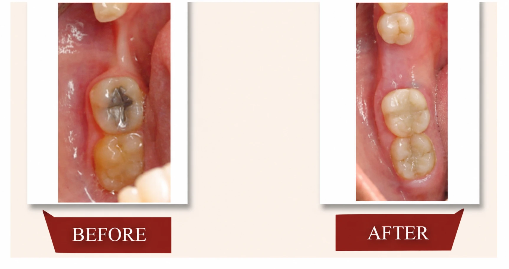 Real patient before and after bone grafting result showing rebuilt jawbone support for future dental implant planning