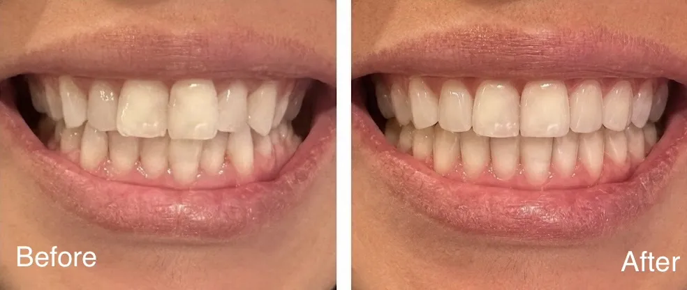 Real patient before and after clear aligner treatment to fix mild crowding