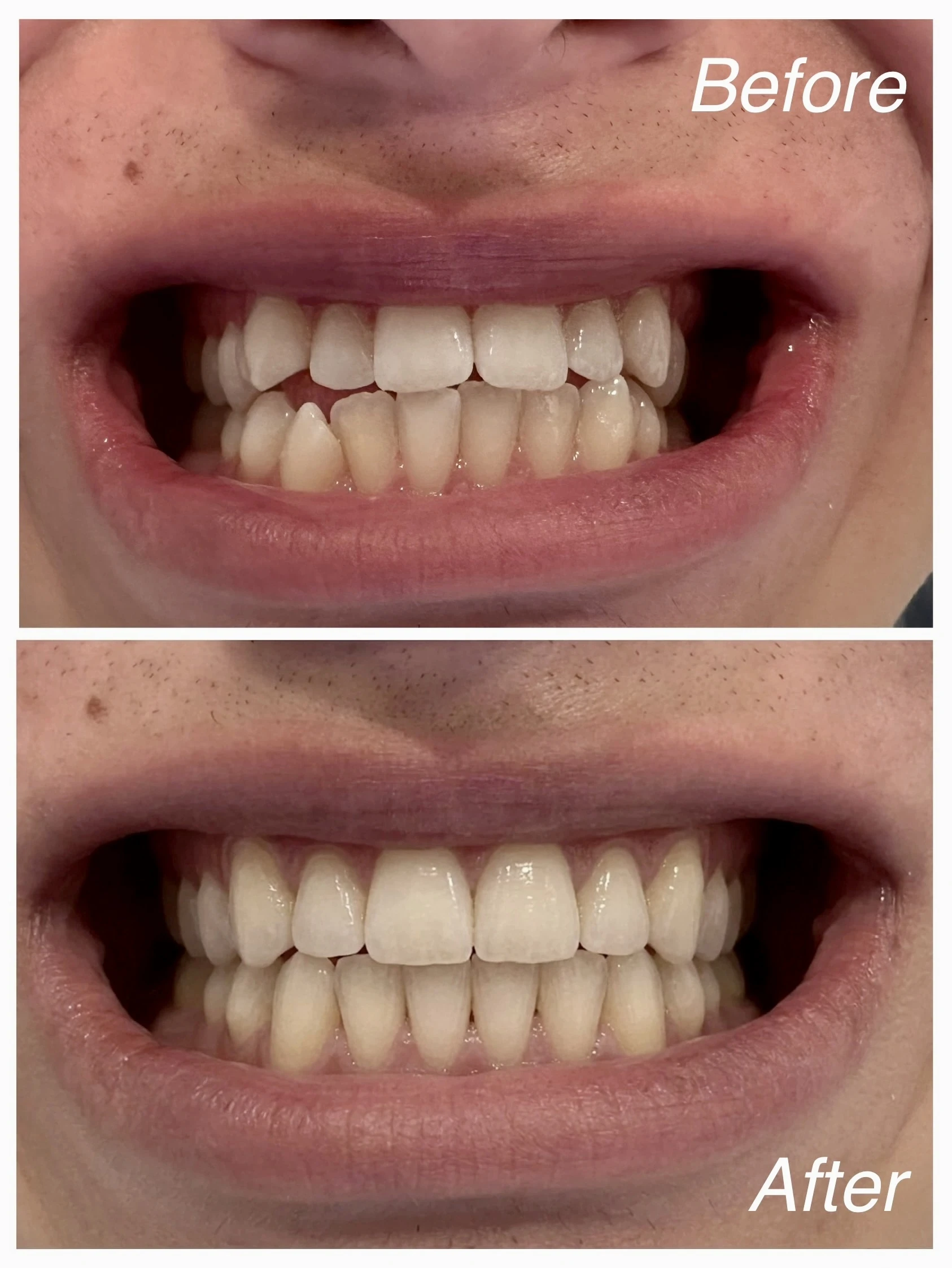 Real patient before and after clear aligner treatment showing improved alignment and bite relationship