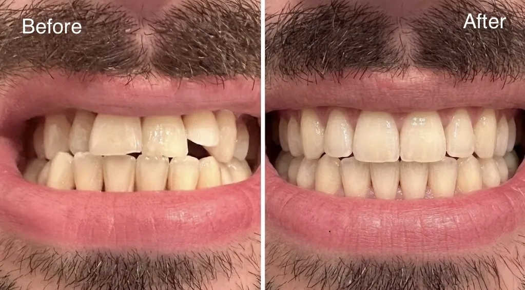 Real patient before and after clear aligner treatment showing improved crowding and bite alignment