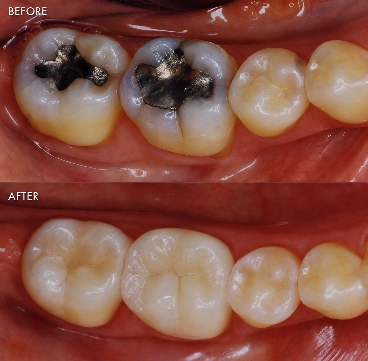 Real patient before and after tooth-colored composite dental fillings replacing older restorations