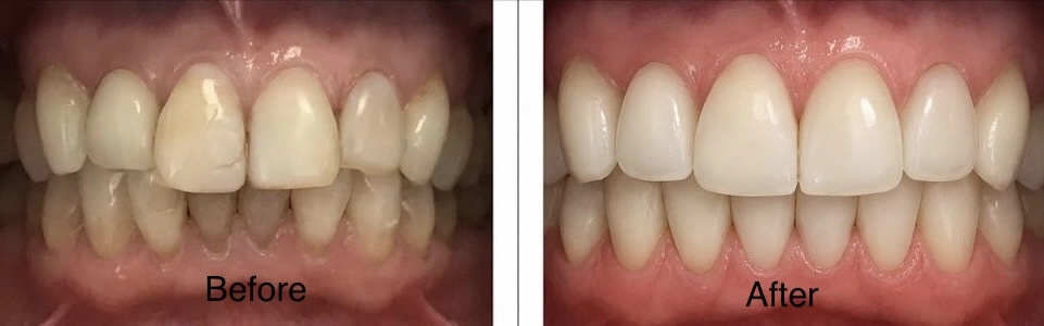 Real patient before and after composite veneers replacing old discolored composites for a brighter balanced smile