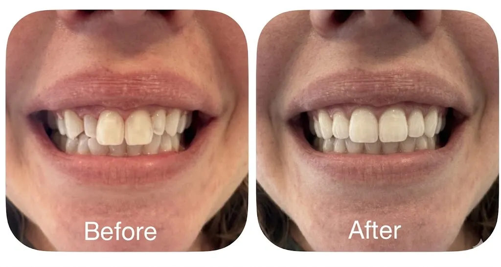 Composite veneer case preserving and contouring the front two teeth while reshaping surrounding teeth for a balanced smile
