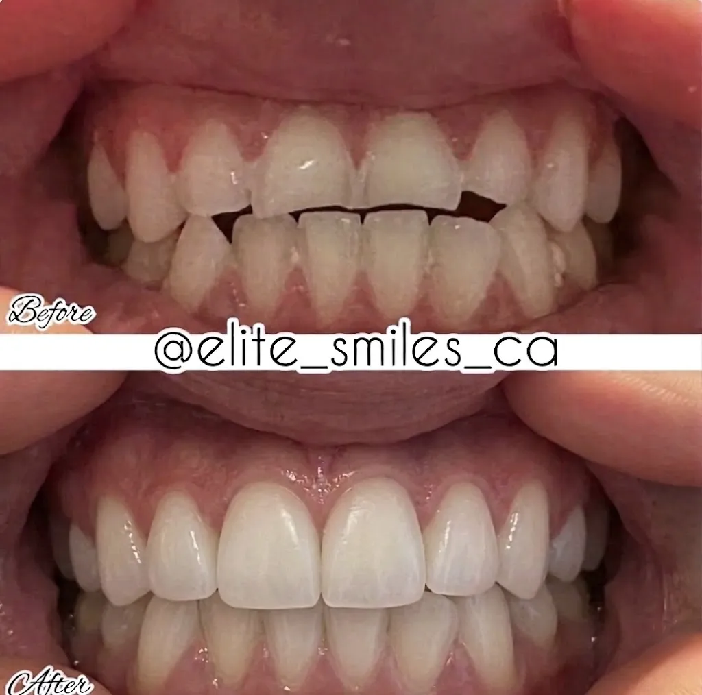 Real patient before and after composite veneers on the top front four teeth