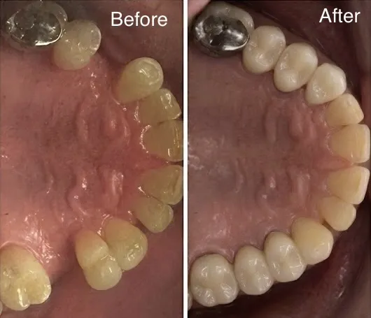 Real patient before and after dental bridge replacing a missing front tooth