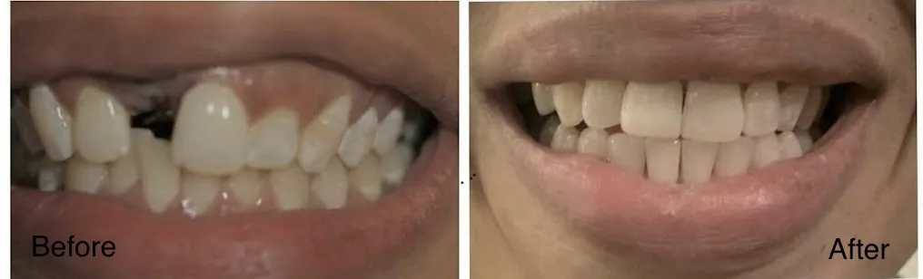 Real patient before and after clear aligner and dental implant treatment improving alignment and replacing missing teeth