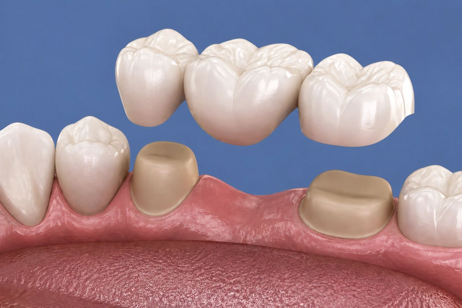 Dental bridges at Elite Smiles of La Jolla