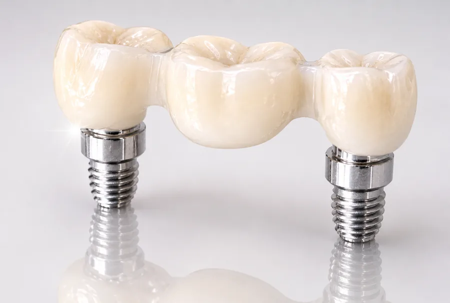 Dental bridges on implants at Elite Smiles