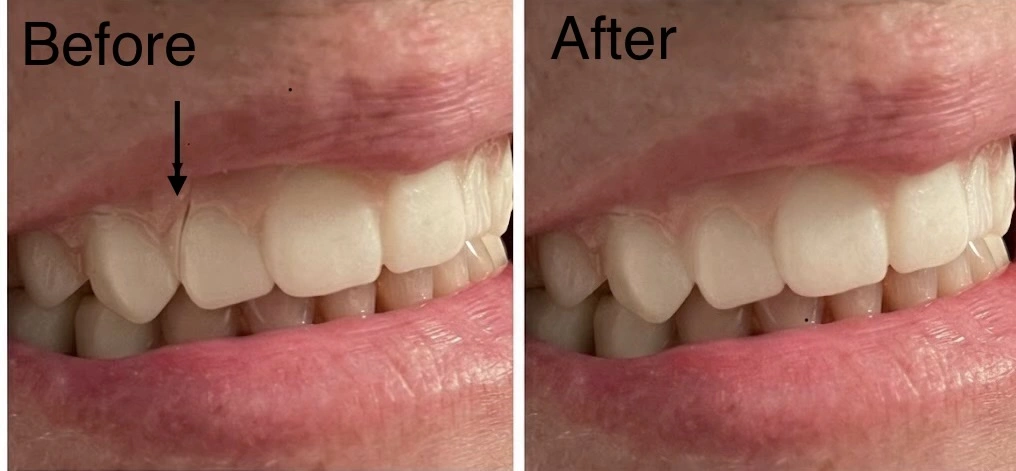 Real patient before and after denture repair showing a broken denture tooth restored