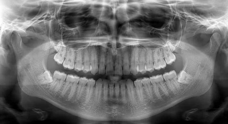 Digital dental X-ray technology at Elite Smiles of La Jolla and Elite Dental Care in Chula Vista