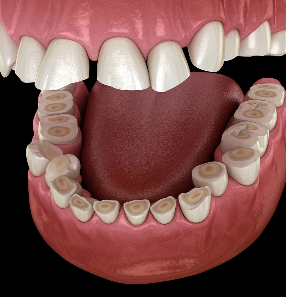 Full mouth reconstruction planning showing prepared teeth for restorative treatment
