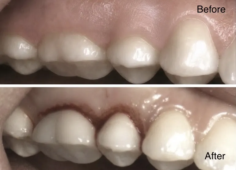 Real patient before and after gum contouring showing a more balanced gumline