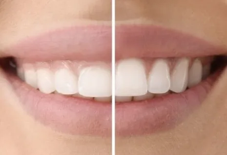 Before and after gum contouring smile result