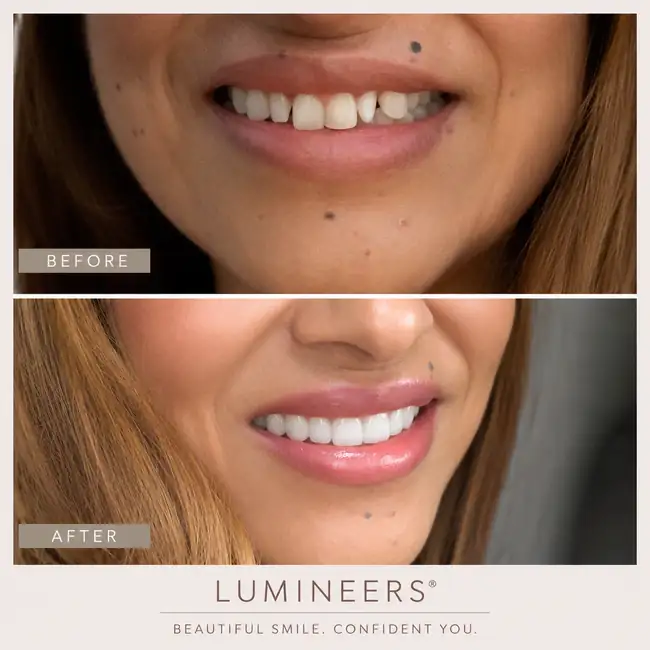 Before and after Lumineers cosmetic dental treatment