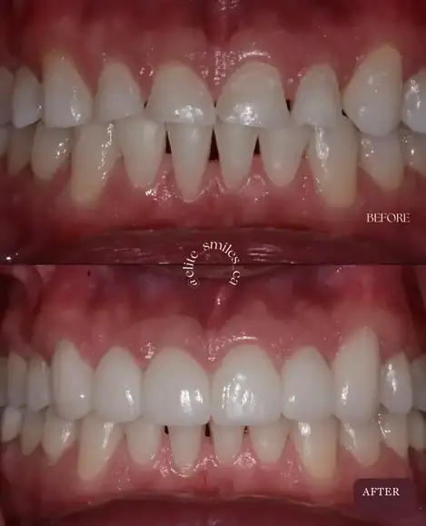 Before and after porcelain veneers smile transformation