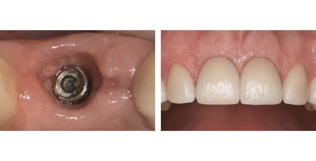 Real patient before and after implant crown restoration on a front tooth