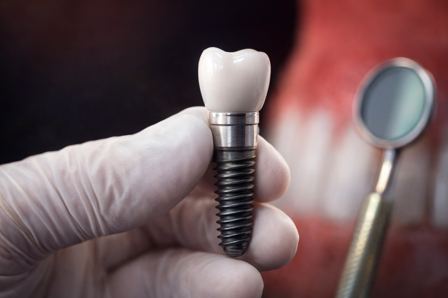 Dental Implants