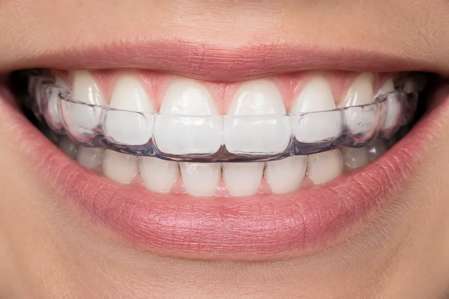 Custom night guard at Elite Smiles