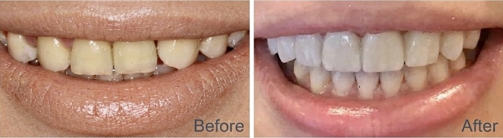 Real patient before and after porcelain veneers on the upper teeth with the canine reshaped to resemble a missing lateral tooth