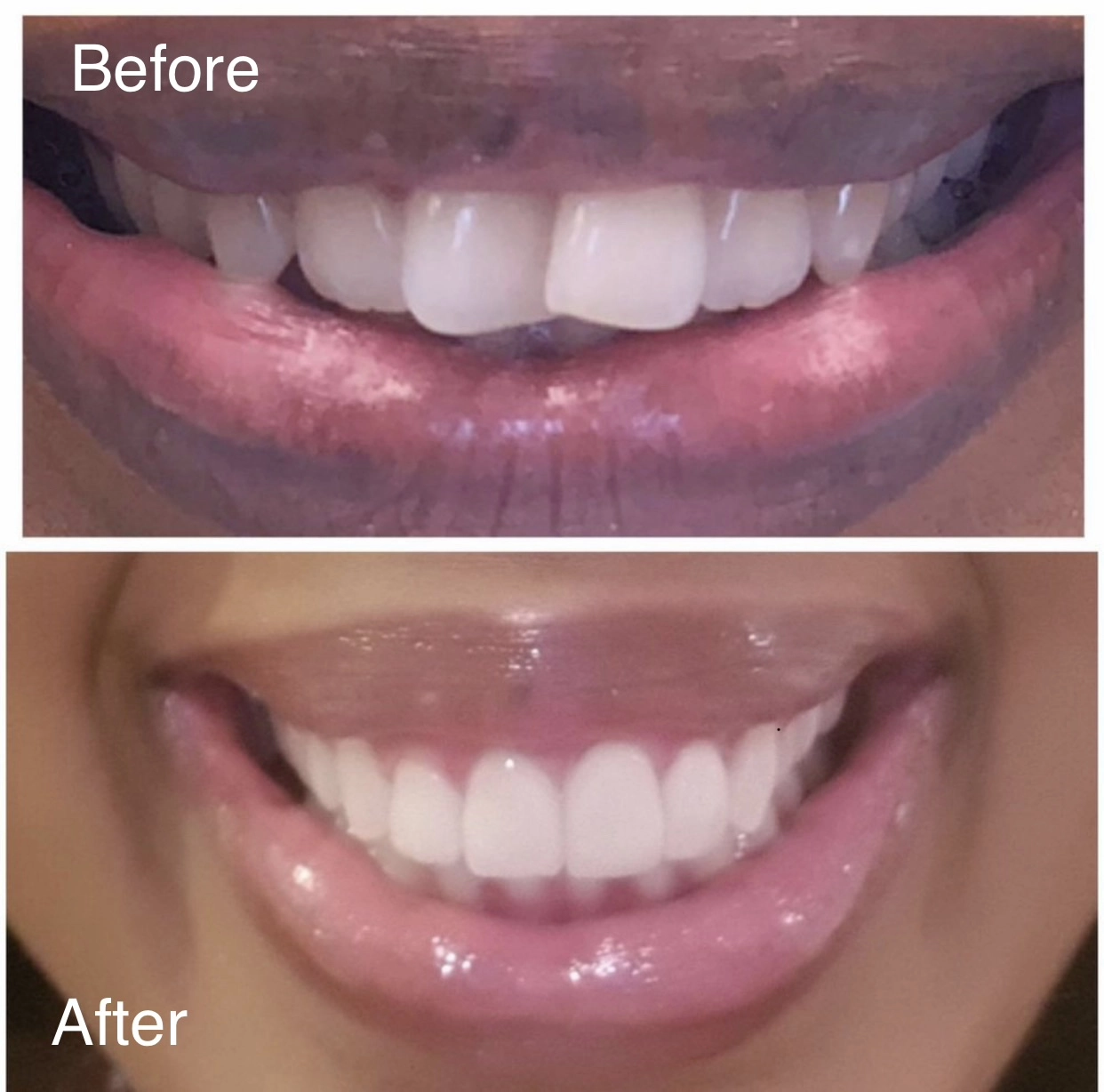 Real patient before and after porcelain veneers showing a brighter and more even smile shape