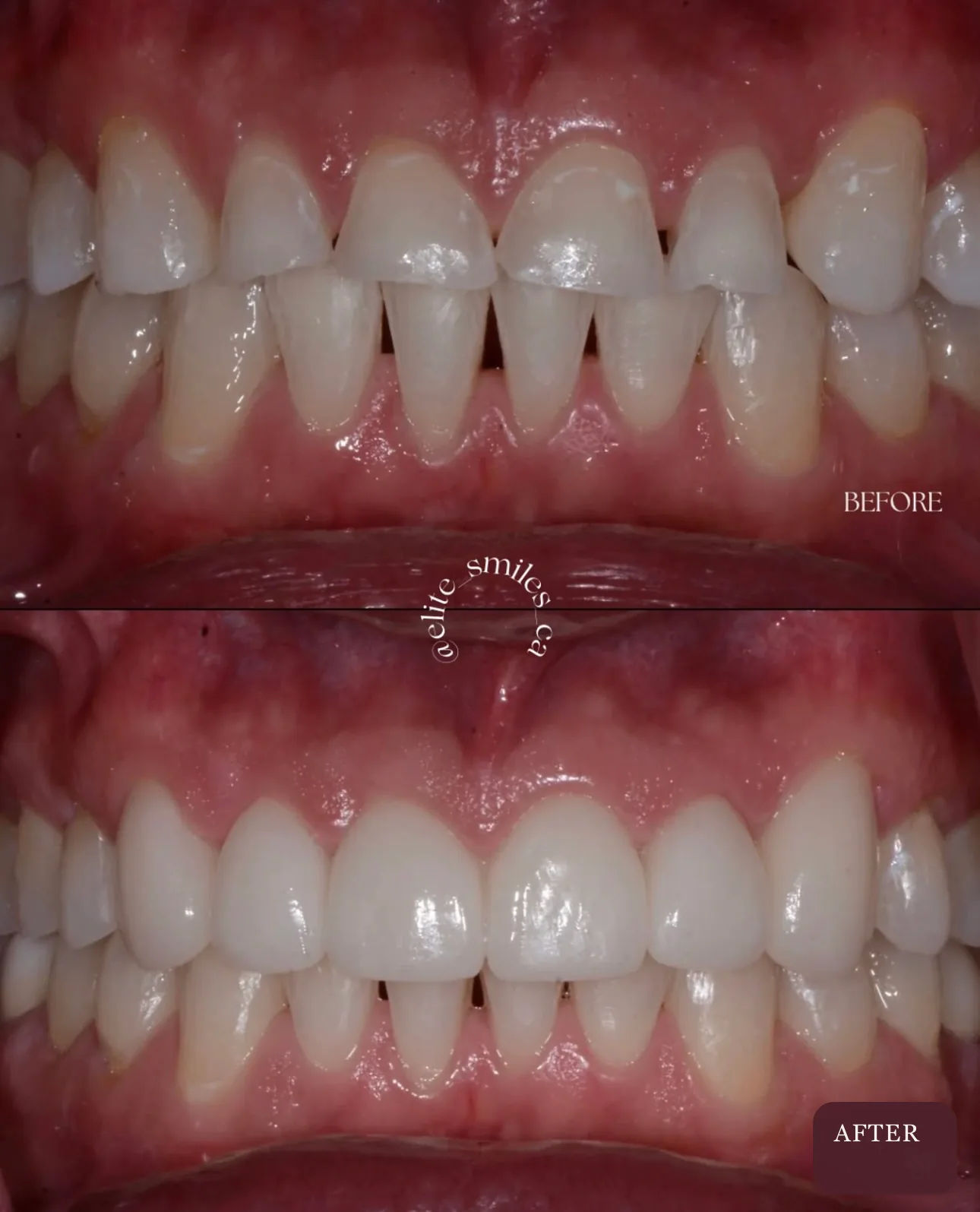 Before and after porcelain veneers smile transformation