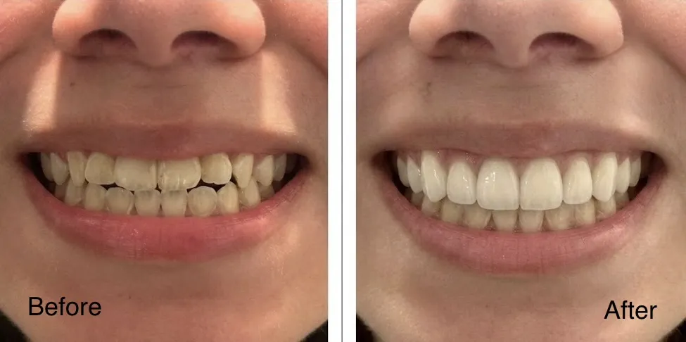 Real patient before and after porcelain veneers showing the top 8 teeth restored for a brighter balanced smile