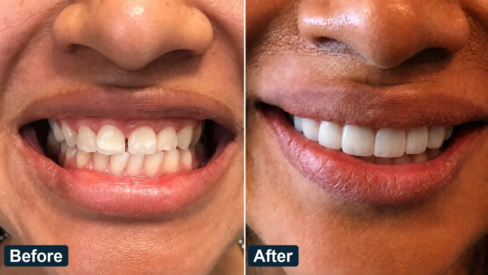 Real patient before and after porcelain veneers showing upper teeth restored for a brighter and more balanced smile