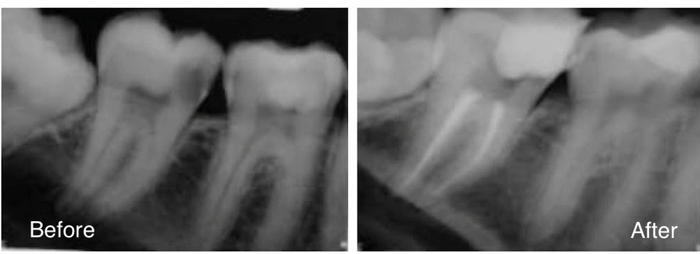 Real patient before and after root canal X-rays showing treated tooth canals filled and sealed