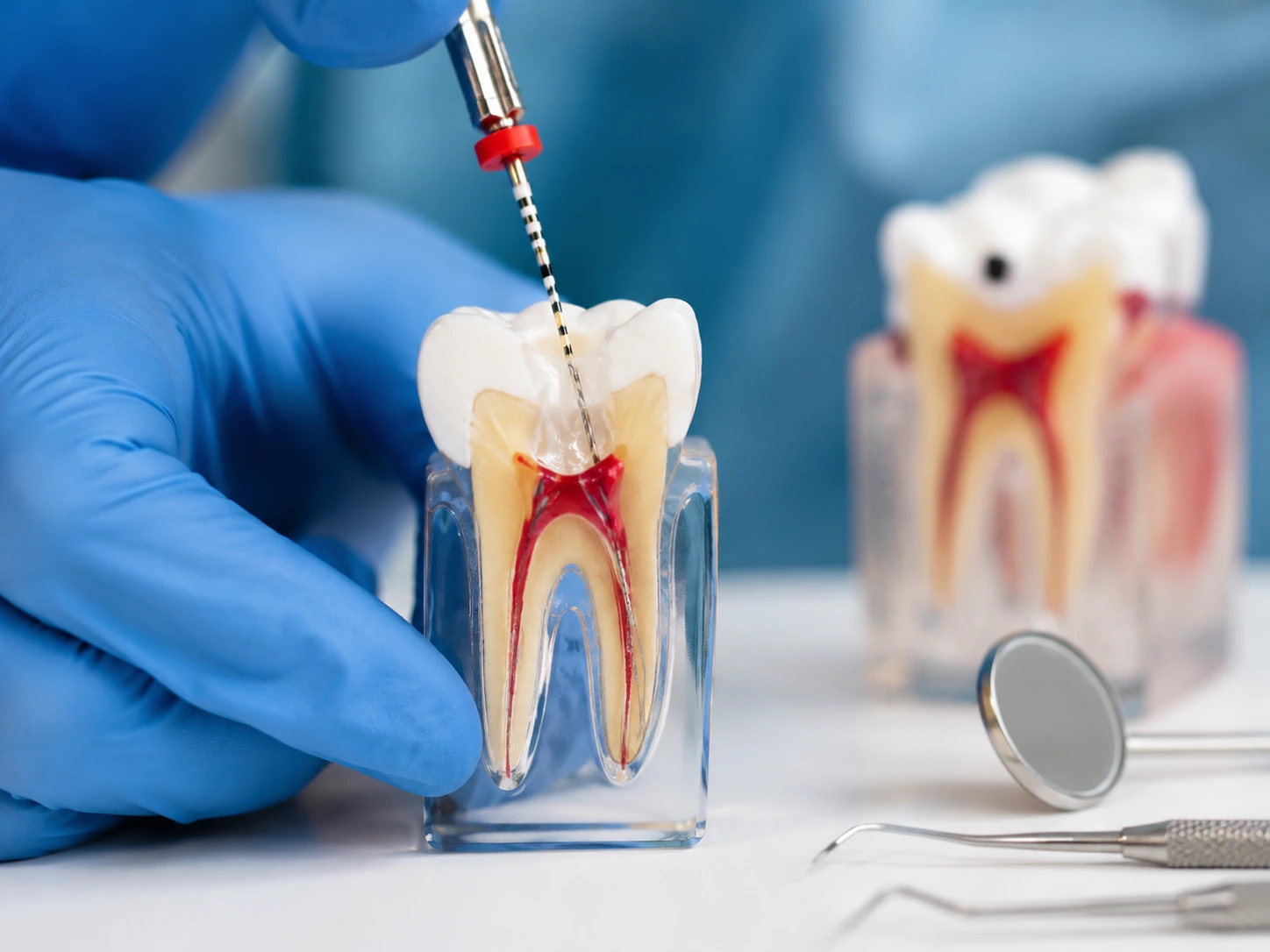 Root canal therapy at Elite Smiles of La Jolla
