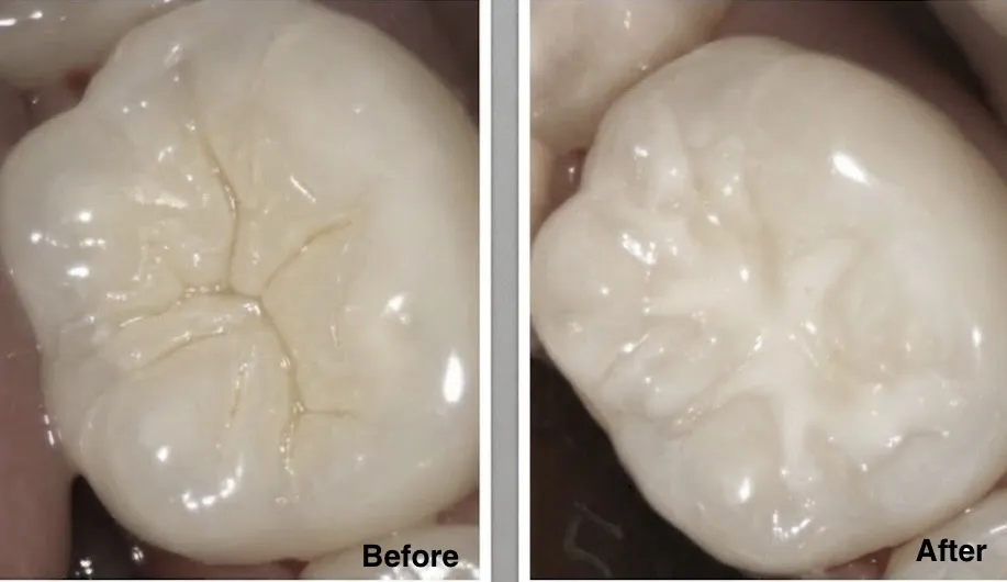 Real patient before and after dental sealant applied to deep molar grooves