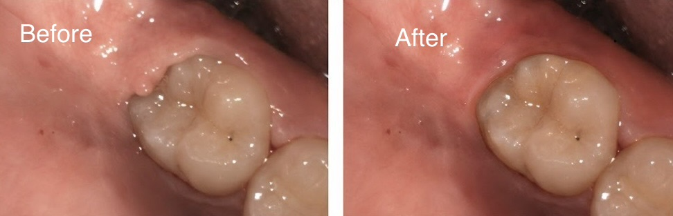 Real patient before and after operculectomy soft tissue procedure around a back tooth