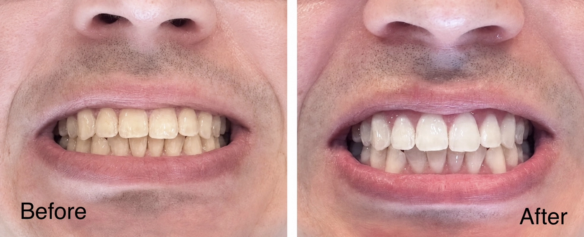 Real patient before and after professional teeth whitening showing a brighter smile after whitening treatment