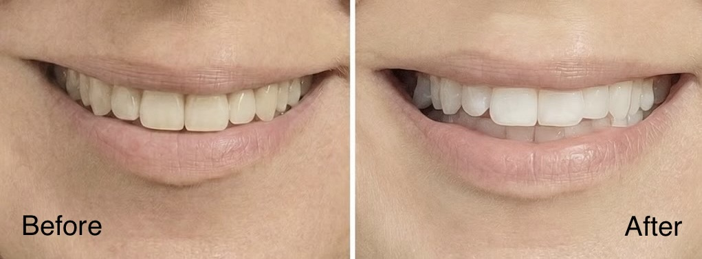 Real patient before and after professional teeth whitening showing a brighter tooth shade after treatment