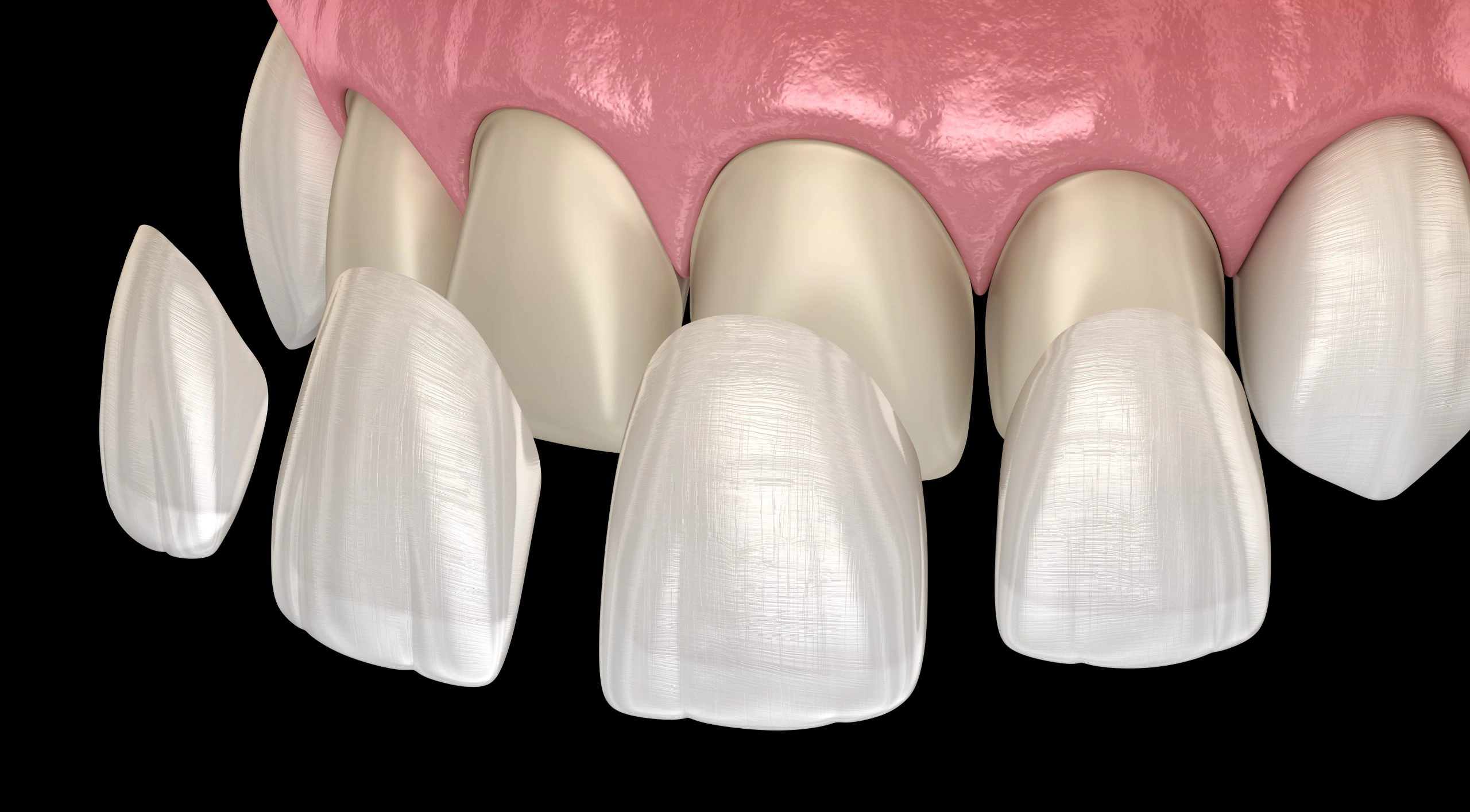 Illustration showing thin porcelain veneers placed over conservatively prepared front teeth